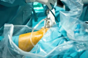 Arthroscopy Explained